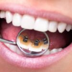 Установка брекетов взрослым: стоит ли бояться? 1cd533979fc021990ef3c332397cae4b